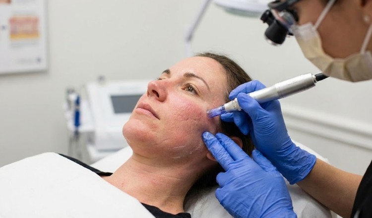 Microneedling for acne scars: how it works