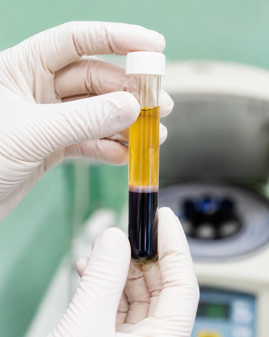 A provider preparing a centrifuge tube of platelet-rich plasma in a clean clinical setting